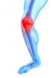 painful-knee-illustration-14526284